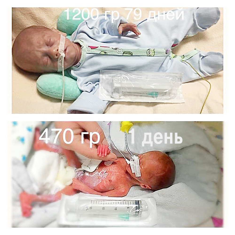 «При рождении Марк весил 730 граммов, а Захар — 470! Сейчас мальчикам уже год и они практически здоровы»