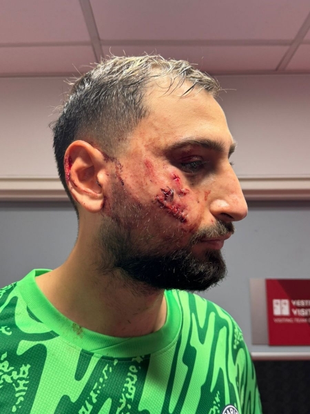 Чемпіону Європи з футболу спотворили обличчя у матчі чемпіонату Франції: відео жахливого зіткнення